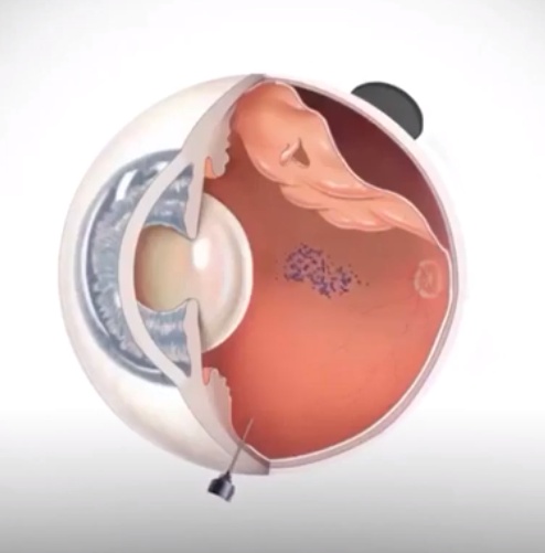 Magnetic nanoparticles in medicine